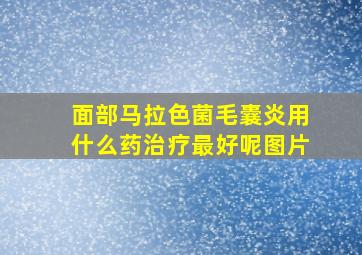 面部马拉色菌毛囊炎用什么药治疗最好呢图片